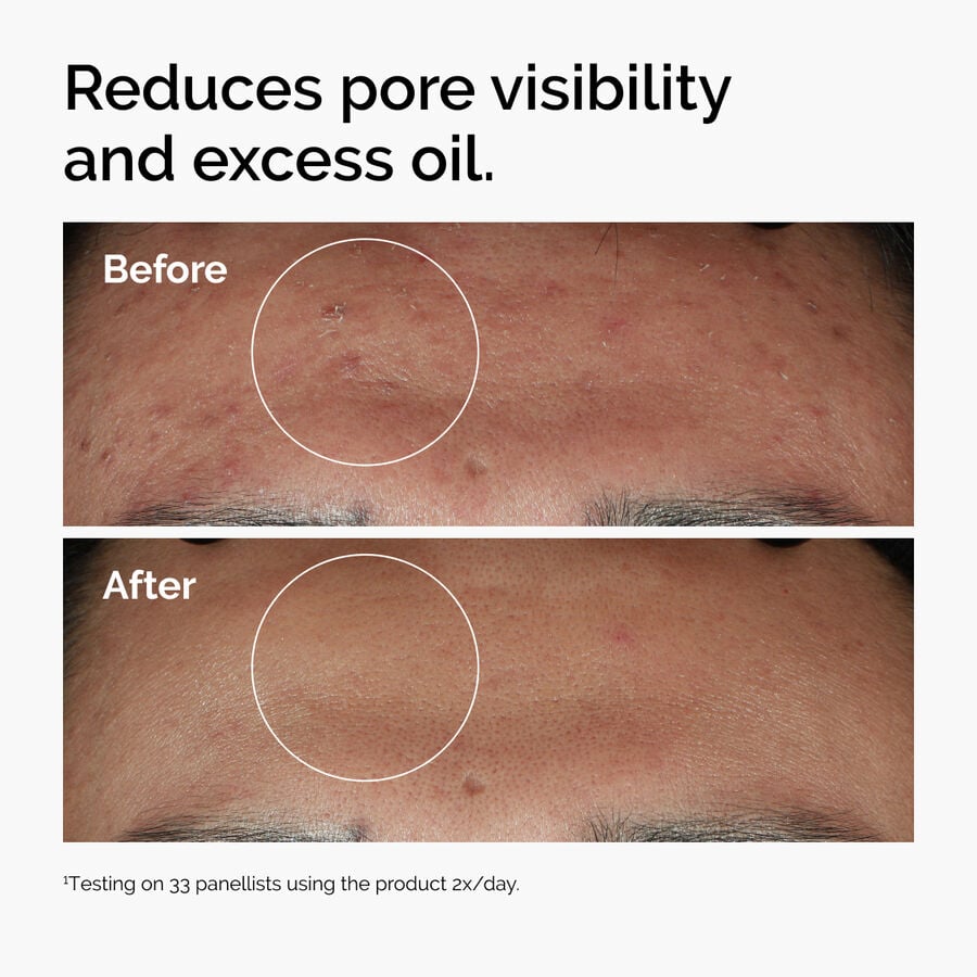niacinamide-10-zinc-1-x2 ord-niacinamide-zinc-blemish-serum-before-after-pores.jpg