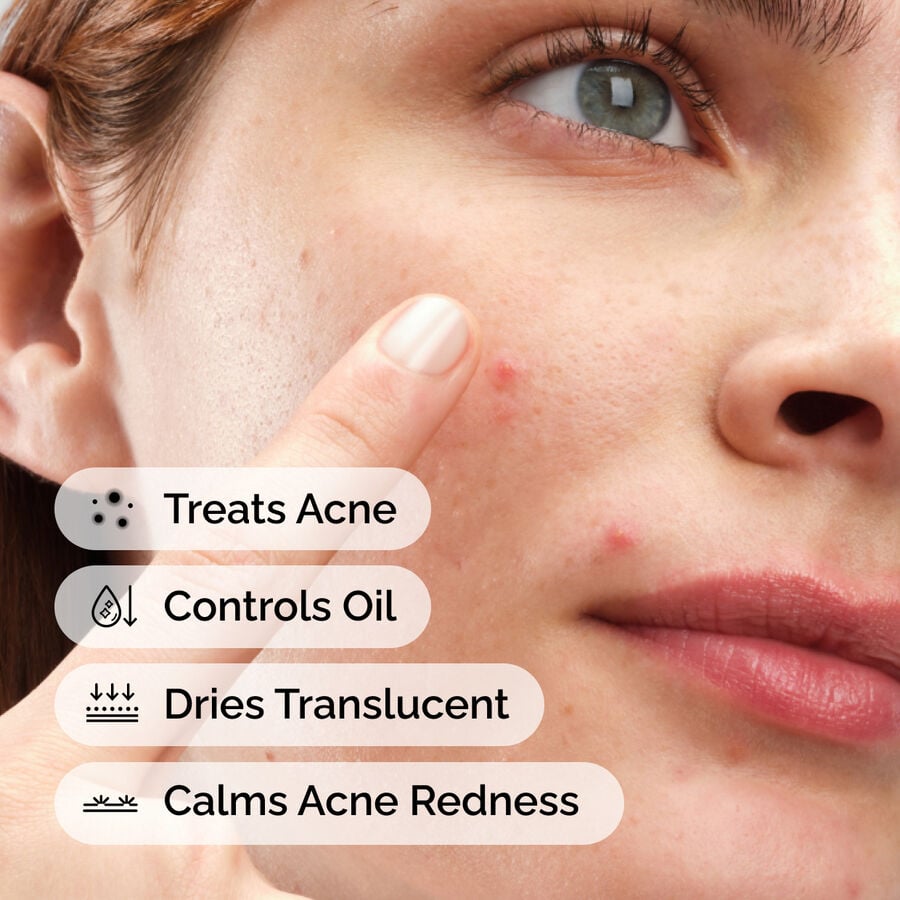 sulfur-10-powder-to-cream-concentrate-s8 ord-sulfur-10pct-powder-to-cream-concentrate-model-application-with-benefits-acne.jpg