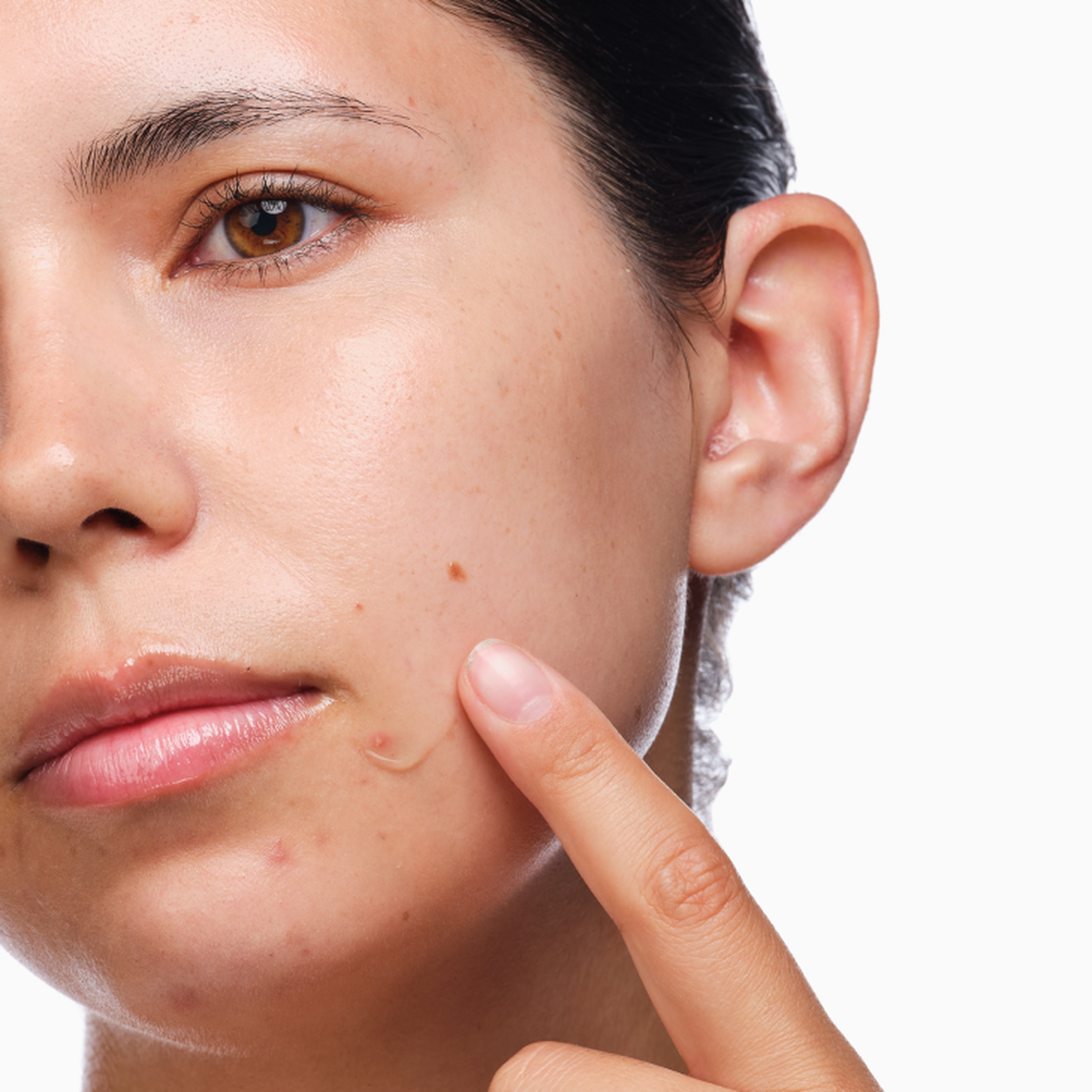 the-acne-set-x5 rdn-the-acne-set-application.png